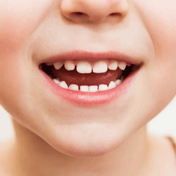 پیشگیری-از-پوسیدگی-دندان